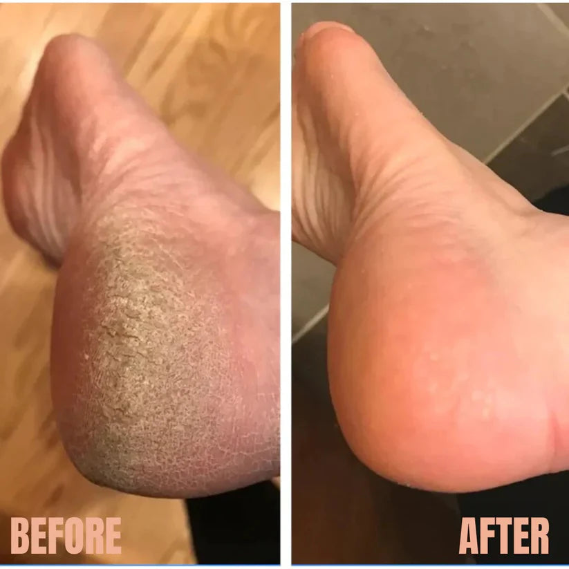 Electric Pedicure Dead Skin Remover with one year warranty